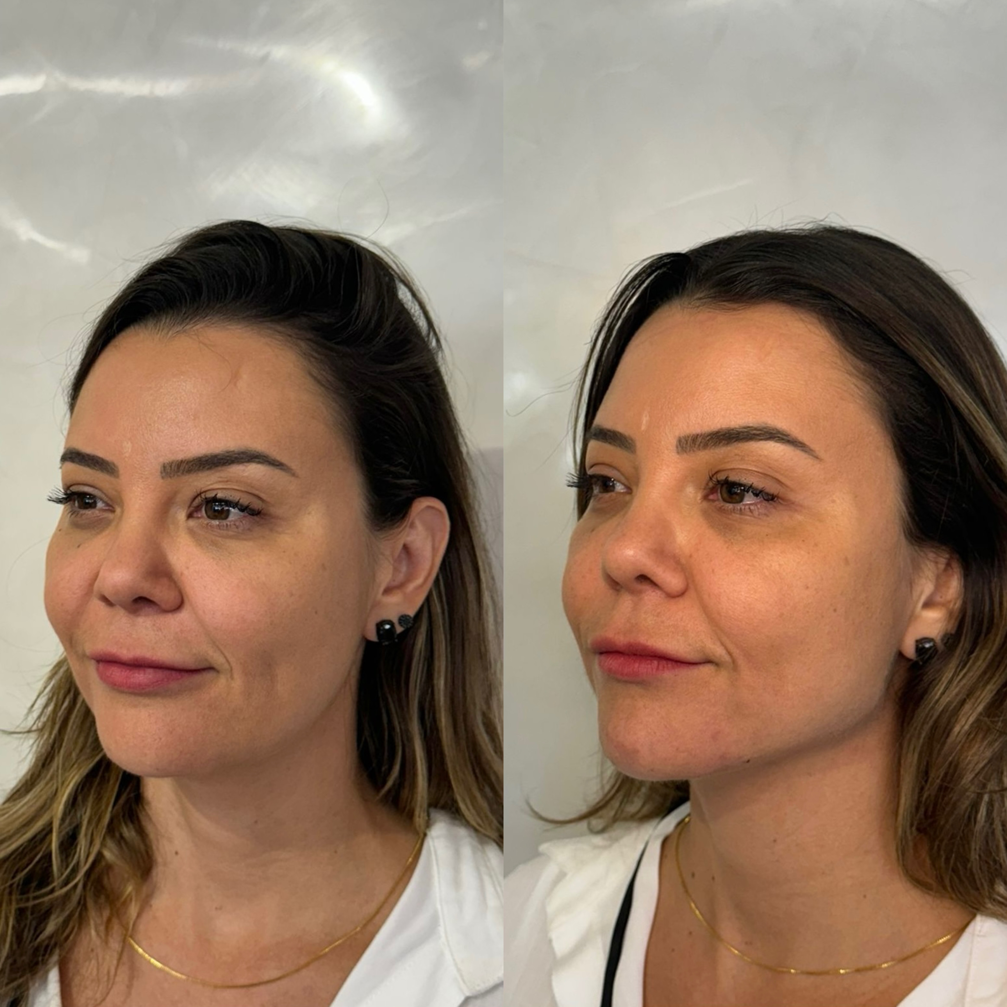 Contorno facial