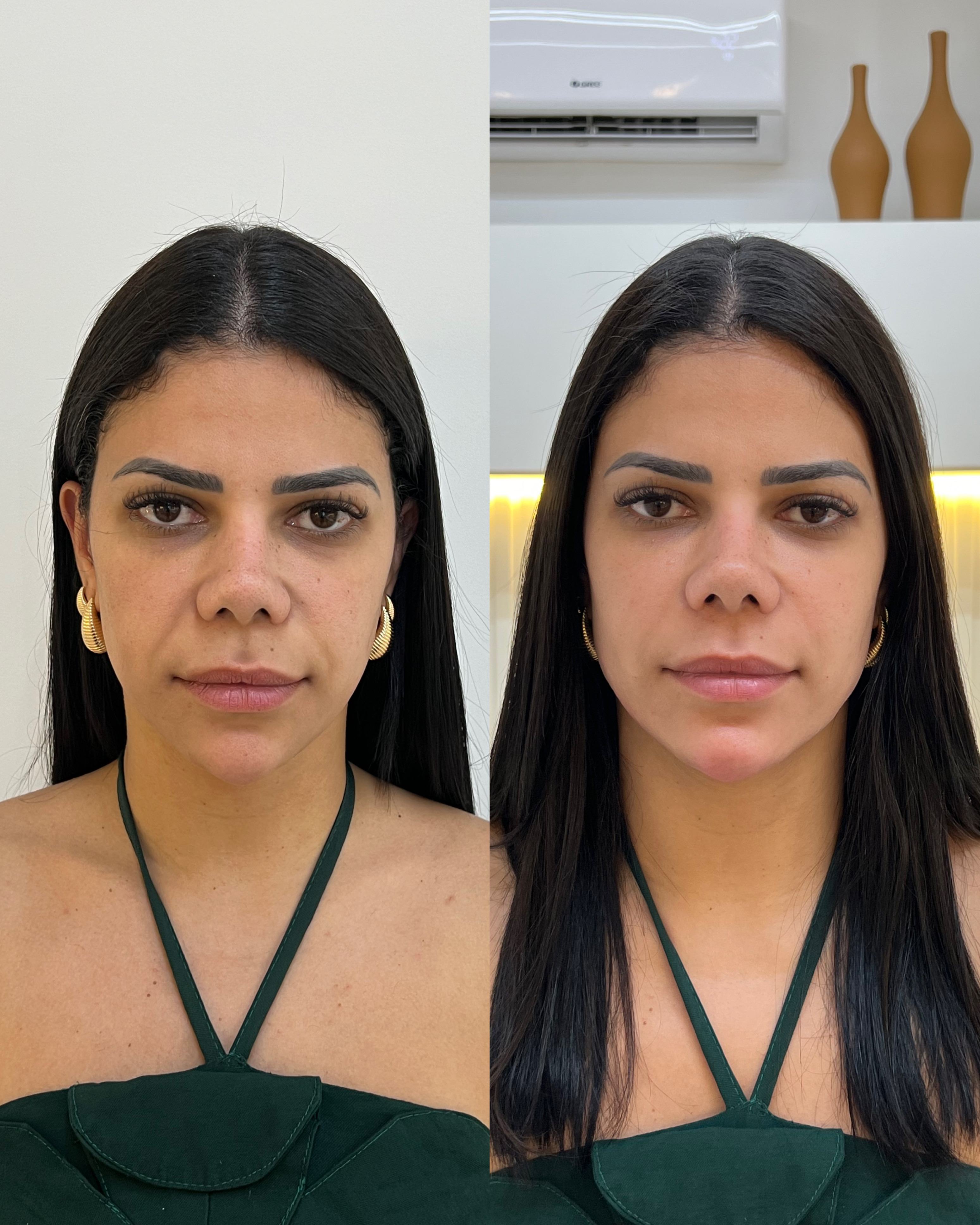 Rejuvenescimento sutil